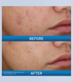 Acne Foaming Cream Wash - Image 3